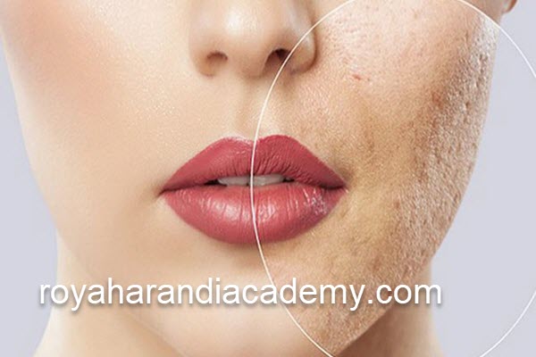 لیزر کیوسوئیچ و هایفوتراپی در مرکز معتبر | آکادمی رویا هرندی