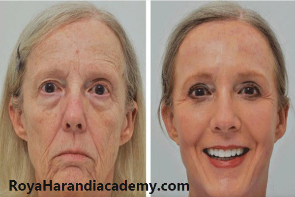 هزینه دوره های جوانسازی صورت