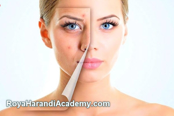 پکیج های درمانی جوش | آکادمی رویا هرندی