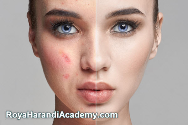 پکیج های درمانی لک | آکادمی رویا هرندی