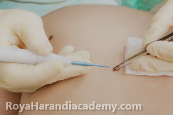 انواع خال | آکادمی رویا هرندی