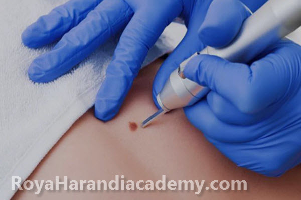 علائم خطرناک بعد از برداشتن خال