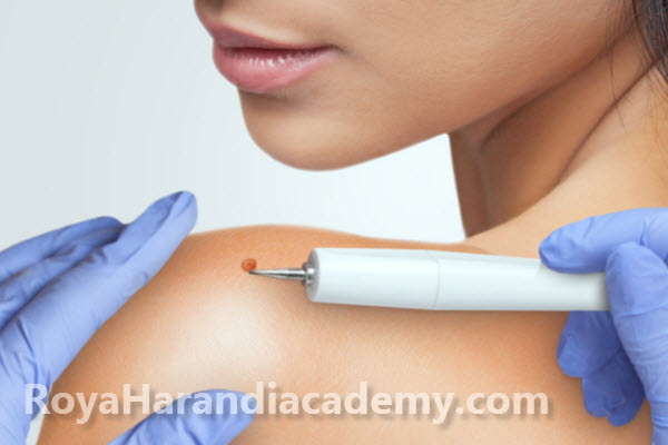 بهترین خالبرداری و پلاسما با جدیدترین دستگاه 2024