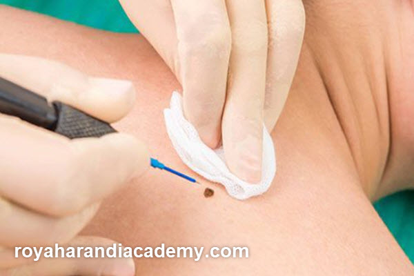 مراقبت های بعد از برداشتن خال با پلاسما | آکادمی رویا هرندی