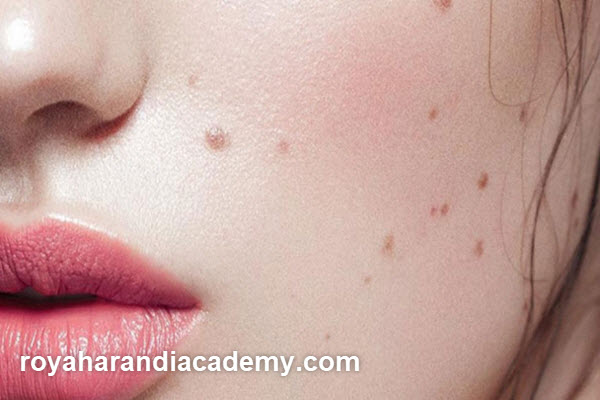 هزینه برداشتن خال با پلاسما در غرب تهران | آکادمی رویا هرندی