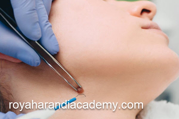 قیمت برداشتن خال با پلاسما | آکادمی رویا هرندی