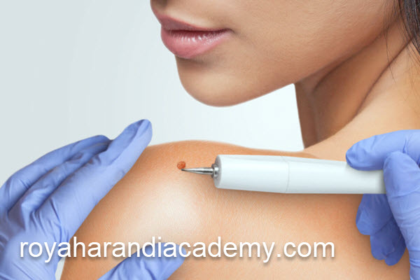 بررسی قیمت برداشتن خال با روش پلاسما در جنت آباد | آکادمی رویا هرندی