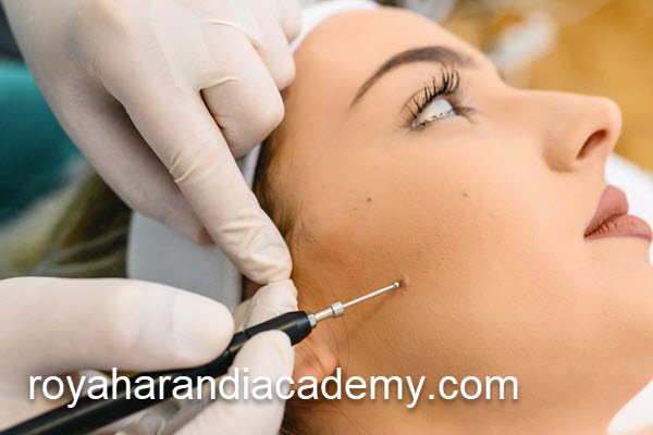 برداشتن خال با روش پلاسما در پونک | آکادمی رویا هرندی