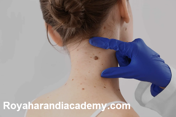 هزینه برداشتن خال با پلاسما