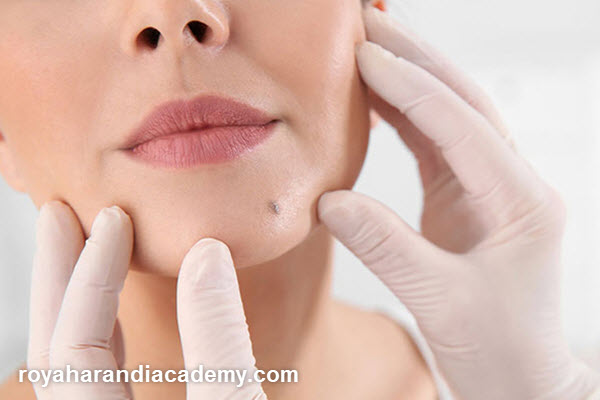 دلایل انتخاب بهترین فصل برای برداشتن خال صورت