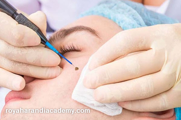 بهترین فصل برای برداشتن خال صورت