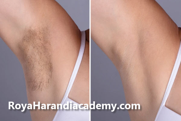 نکات مهم کربن تراپی زیر بغل